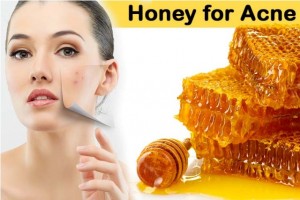 honey for get rid of acne pimples